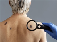 Dermatolog Ćurić upozorava: Koža pamti svaku opeklinu, a melanom je...