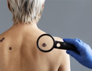Dermatolog Ćurić upozorava: Koža pamti svaku opeklinu, a melanom je...