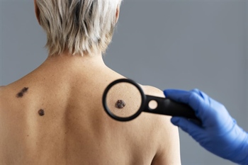 Dermatolog Ćurić upozorava: Koža pamti svaku opeklinu, a melanom je gotovo 100 posto izlječiv ako se otkrije na vrijeme