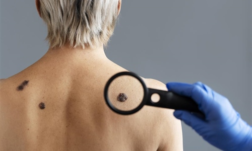 Dermatolog Ćurić upozorava: Koža pamti svaku opeklinu, a melanom je...