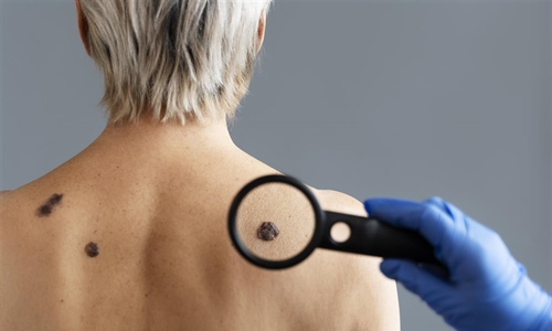 Dermatolog Ćurić upozorava: Koža pamti svaku opeklinu, a melanom je...
