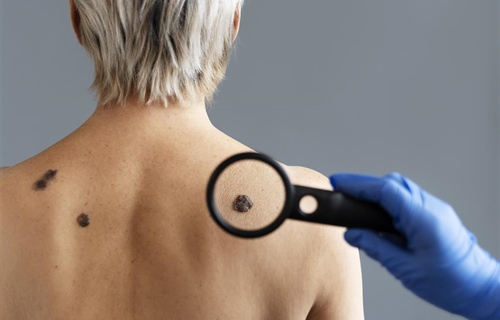 Dermatolog Ćurić upozorava: Koža pamti svaku opeklinu, a melanom je...