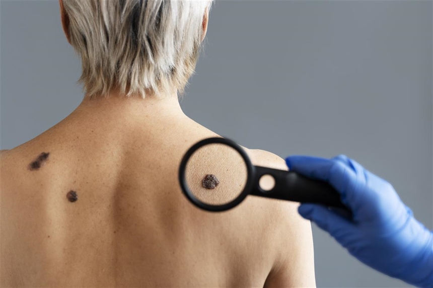 Dermatolog Ćurić upozorava: Koža pamti svaku opeklinu, a melanom je gotovo 100 posto izlječiv ako se otkrije na vrijeme