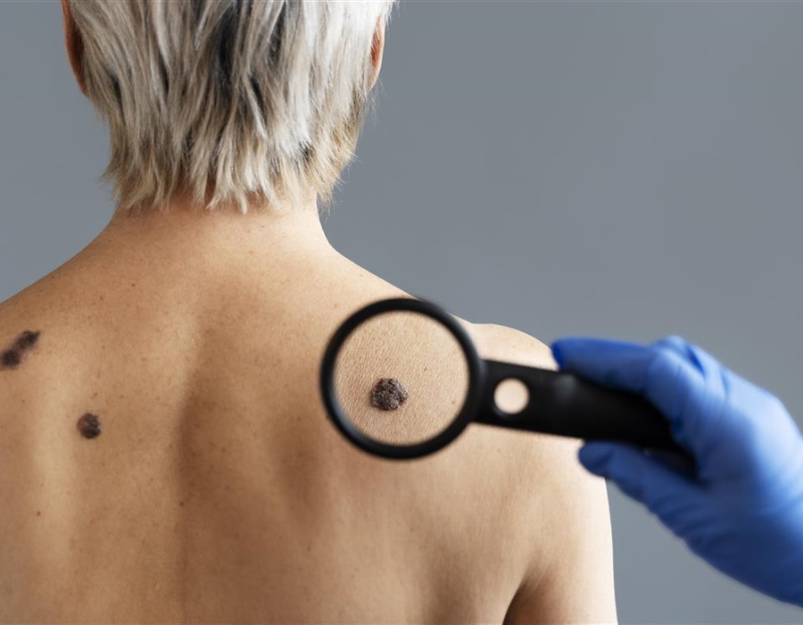 Dermatolog Ćurić upozorava: Koža pamti svaku opeklinu, a melanom je...
